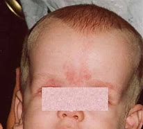 Image result for Prader-Willi Syndrome Information
