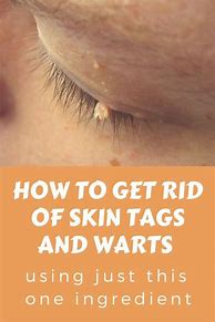Image result for How to Remove Skin Tags