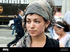 Image result for Pretty Girl with Acne Scars