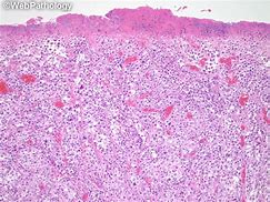 Image result for Ulcerated Melanoma