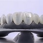 Image result for What Are Composite Veneers