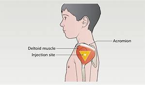 Image result for Deltoid Injection Site