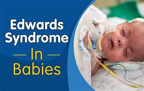 Image result for Pictures Babies Edwards Disease