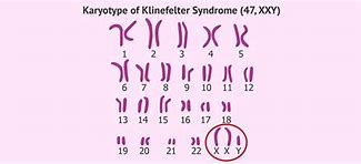 Image result for Turner Karyotype Klinefelter's and S