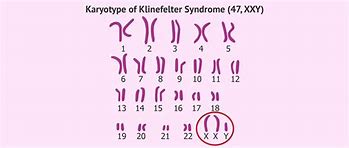 Image result for Karyotype for Klinefelter's Syndrome
