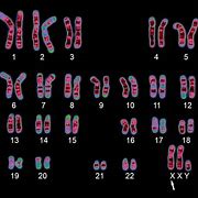 Image result for Trisomy XXY