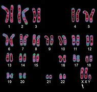 Image result for Klinefelter Syndrome DNA