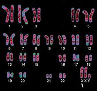 Image result for XXY Chromosome Human