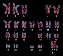 Image result for Male Karyotype with Klinefelter's Syndrome