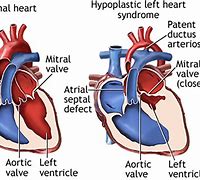 Image result for Hypoplastic Left Heart Syndrome VSD