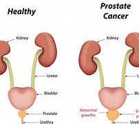 Image result for Prostate Cancer Stages