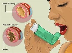 Image result for Asthma Treatment Cartoon
