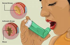 Image result for Asthma and Allergy