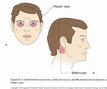 Image result for Battle Sign Neuro Exam
