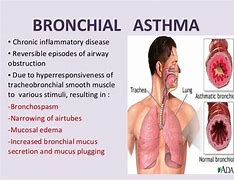 Image result for Bronchial Asthma Symptoms