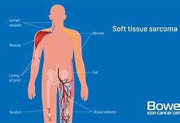 Image result for Sarcoma Cancer Stage 4
