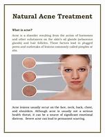 Image result for Natural Acne Treatment