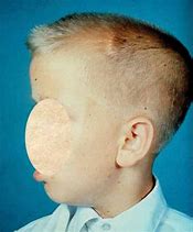 Image result for A Male with XYY Syndrome