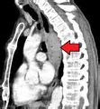 Image result for Esophageal Cancer Treatment