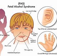 Image result for Scan Fetal Alcohol Syndrome