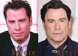 Image result for John Travolta Surgery