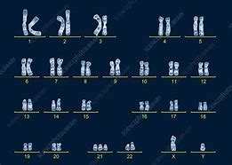 Image result for Isochromosome Karyotype Down Syndrome