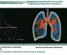 Image result for Bronchial Asthma in Children