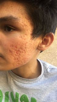 Image result for Red Acne Scars