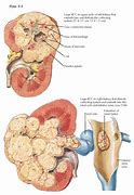 Image result for Stage 4 Renal Cancer