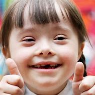 Image result for Down Syndrome Facial Features