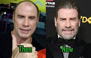 Image result for John Travolta Hair Transplant