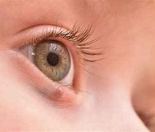 Image result for Eye Cancer
