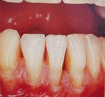 Image result for Dechaussement Des Dents