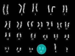 Image result for DiGeorge Syndrome Karyotype