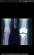 Image result for Knee-Replacement X-ray Joke