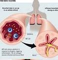 Image result for Asthma Plan for School