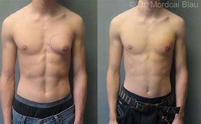 Image result for Male with Gynecomastia