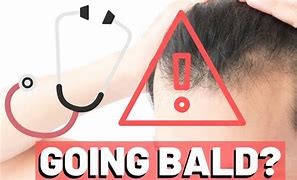 Image result for How to Tell If Your Balding