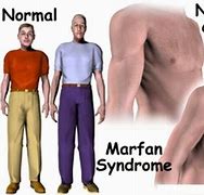Image result for Marfan S Disease