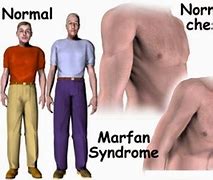 Image result for Marfan Syndrome Symptoms