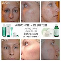 Image result for Arbonne Before and After Skine