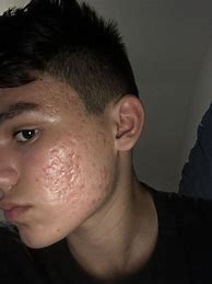Image result for Severe Acne Scars