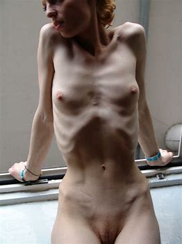 Anorexic nude photos TubeZZZ Porn Photos