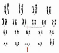 Image result for Isochromosome Karyotype Down Syndrome