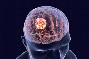 Image result for Brain Tumor