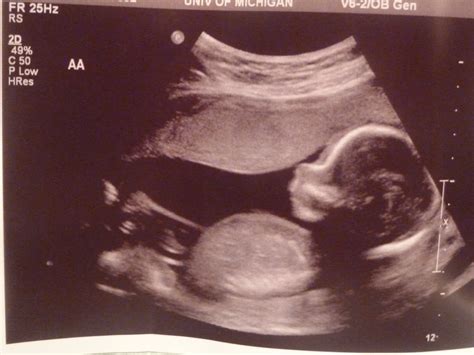 Baby Bitty Twins  18 week ultrasound pics