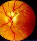 Image result for Retrobulbar Optic Neuritis