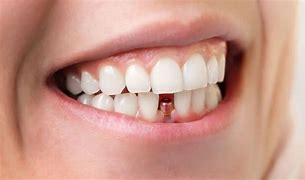 Image result for Protesis Dental
