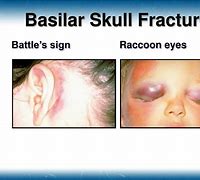 Image result for Battle Sign Posterior Fossa Fracture
