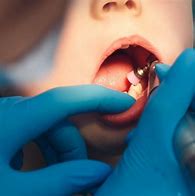 Image result for Water Spray for Teeth Cleaning